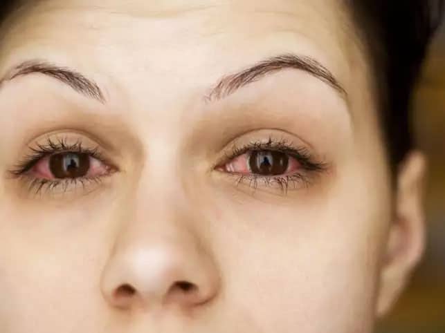 Llanura Establecer Decaer Alergia e Irritación en extensiones de pestañas | MakeupMe Studio