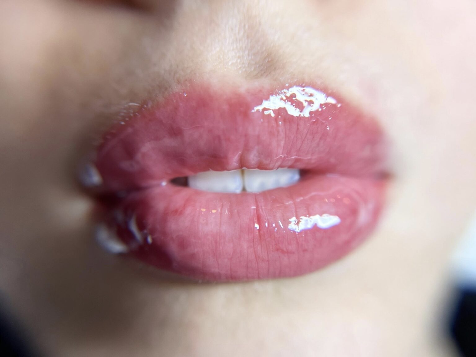 Labios hidratados después de Hidralips con dermapen